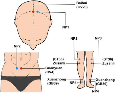 Effect of Moxibustion Treatment on Degree Centrality in Patients With Mild Cognitive Impairment: A Resting-State Functional Magnetic Resonance Imaging Study
